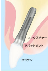 アストラインプラント