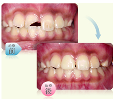 コンポジットレジン