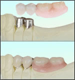 コーヌス・テレスコープ義歯