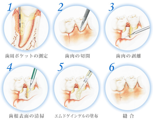 歯周外科手術の流れ