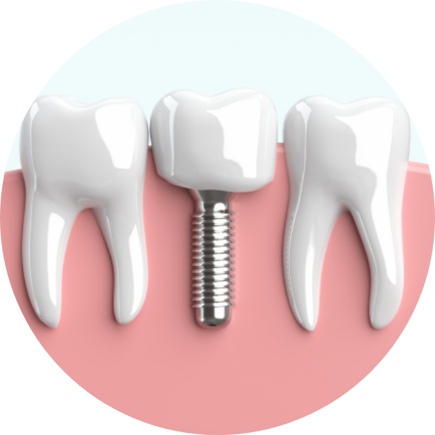 インプラント入れ歯